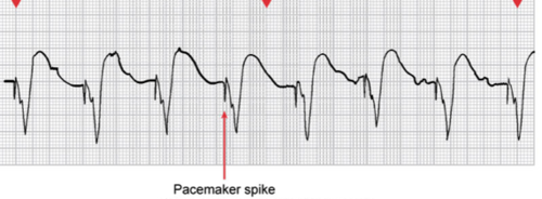 <p><span>pacemaker (cardiac resynchronization therapy)</span><br><span>- can be for slower than normal impulse formation, symptomatic AV or ventricular conduction disturbance</span><br><span>-temporary or permanent</span><br><span>creates an artifical block and can produce Left Bundle Branch Block (LBBB) pattern on ECG</span><br><span>- can be single or dual chamber</span></p>