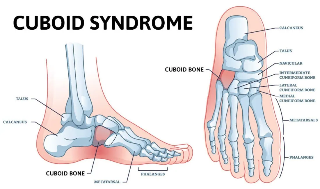 <p>Located anterior to the calcaneus and posterior to the 4th and 5thmetatarsal on the lateral side of the foot.</p>