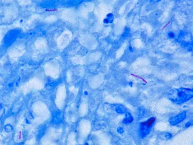 <p>Acid-Fast Bacteria (AFB) </p>
