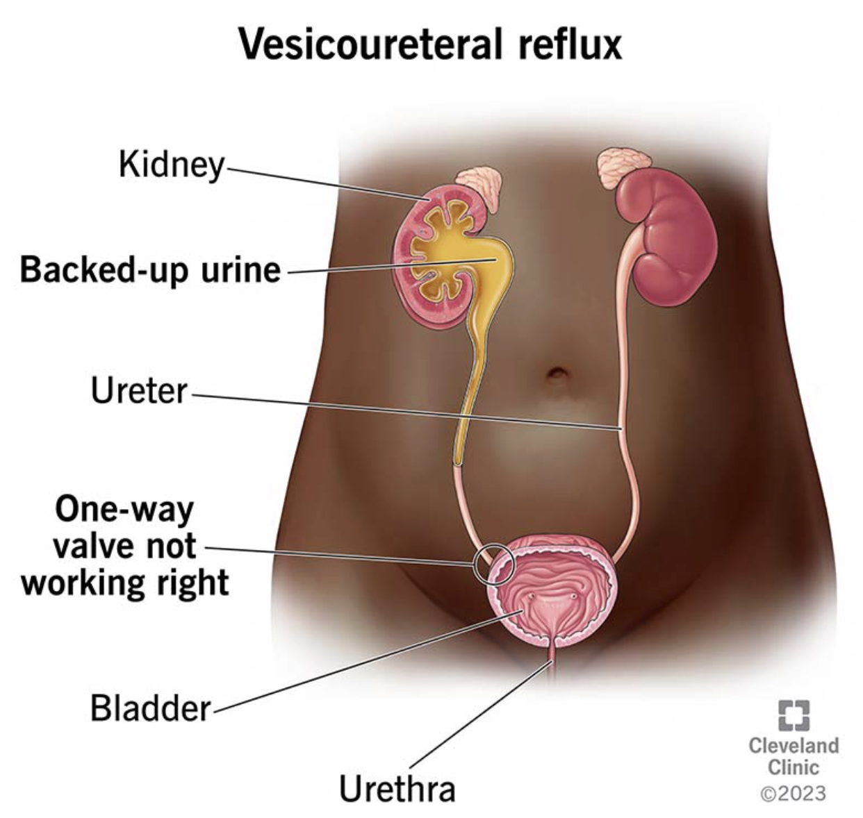 <p>A <strong>specialized one-way flap valve mechanism where each ureter enters the bladder wall</strong>, preventing urine from backing up into the kidneys</p>