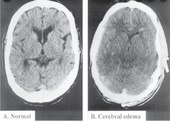 <p>Brain cells swell, leading to cerebral edema, severe neurologic symptoms, brain herniation, and death.</p>
