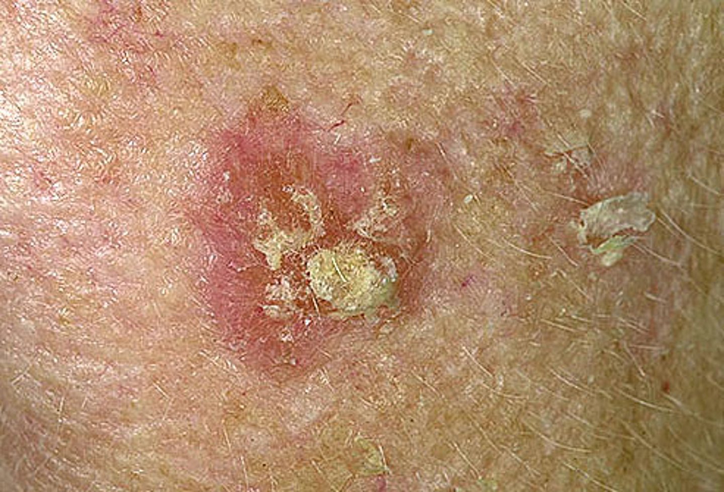 <p>rough, scaly, crusty patches of skin</p><p>-flattened papule covered by dry scale</p><p>-d/t sun damage</p><p>-precursor to squamous cell carcinoma</p><p>-pink, red, or brown in discoloration</p>