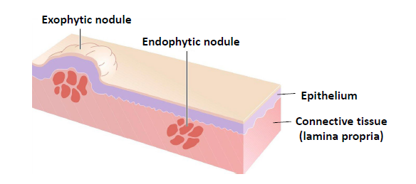 <ul><li><p>a slightly larger papule, less than 2 cm</p></li><li><p>anything larger may be called a tumor or mass</p></li><li><p><strong>exophytic </strong>nodule, grows outward from the surface of the tissue</p></li><li><p><strong>endophytic </strong>nodule, grows into the surrounding tissues and presents as palpable mass with or without any noticeable swelling</p></li></ul><p></p>