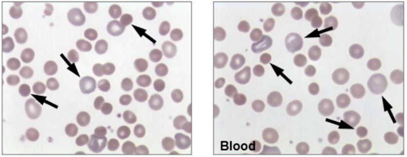 <p>Smear Findings</p><ul><li><p>Spherocytes</p></li><li><p>Looks similar to H. Spherocytosis but positive DAT</p></li></ul><p></p>
