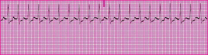 <p>Which rhythm is this?</p>