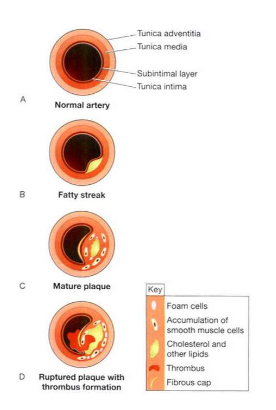 <ul><li><p><strong>Endothelial dysfunction</strong> - lipids accumulate and modify in this area forming <strong>fatty streak</strong></p></li><li><p><strong>Leukocyte recruitment</strong> - includes macrophages from tissue and monocytes from blood</p></li><li><p>These cells phagocytise the lipids, before becoming <strong>foam cells</strong></p></li></ul><p></p>