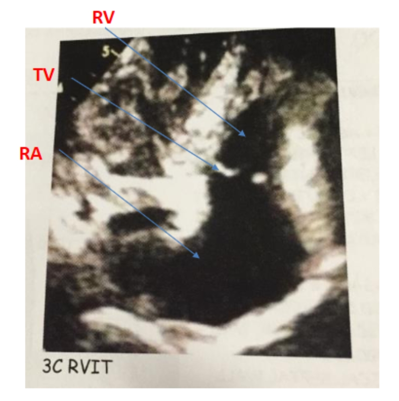 <p>Probe Positioning: Ap3ch RVIT </p>