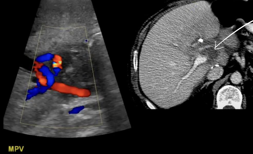 <p>posttransplant lymphoproliferative disorder (PTLD)</p><ul><li><p>hypoechoic area on CT</p></li></ul><p></p>