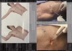 <p>Placed into the 4th or 5th intercostal space, within the anterior mid-axillary line at the bedside with use of analgesics (IV pain medication and local)</p><p>Negative pressure contained system allows for lung re-inflation</p><p>Initially placed to wall suction then transitioned to "waterseal" prior to removal</p><p>If lung fails to reinflate with chest tube, may need OR and pleurodesis (glue lung tissue to chest cavity)down the road</p>