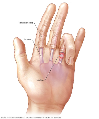 <ul><li><p>Tendon</p><ul><li><p>Helps finger bend toward the palm</p></li><li><p>Surrounded by sheath</p><ul><li><p>Lined with synovium: produces fluid to help tendon glide as finger bends and straightens</p></li></ul></li><li><p>In trigger finger, tendon inflames and sheath thickens</p><ul><li><p>Typically involves one finger: tendon or sheath becomes very inflamed and enlarged and cannot fit through smoothly and becomes stuck in a bent position (usually at lower portion of finger)</p></li><li><p>Finger remains bent when asked to straighten finger: may feel a pop as it straightens</p></li><li><p><strong>Can be mechanically extended: is the pulley of the flexor tendon that is the problem</strong></p></li></ul></li></ul></li><li><p>Treatment</p><ul><li><p>Conservative</p><ul><li><p>NSAIDs</p></li><li><p>Cortisone injection: need U/S guidance to make sure you do not rupture the structures</p></li><li><p>PT/OT</p></li><li><p>Splinting</p></li></ul></li><li><p>Surgical</p><ul><li><p>Tendon sheath incision/A1 pulley release</p><ul><li><p>Open the tendon sheath and unroof it</p></li></ul></li></ul></li></ul></li></ul><p></p><p></p>