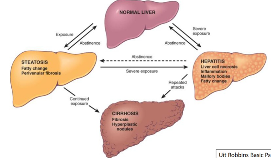 <p>1. Normal Liver (Gezonde lever)</p><p>Dit is je uitgangspunt. De lever is mooi glad en roodbruin.</p><p>2. Steatosis (Leververvetting)</p><p>Zodra je (overmatig) drinkt, verschuift de stofwisseling in de lever (denk aan het vorige plaatje met <span>NAD+ en NADH</span>). De lever stopt met het verbranden van vet en begint het op te slaan.</p><ul><li><p><strong>Kenmerk:</strong> De lever wordt geel en groter.</p></li><li><p><strong>Reversibiliteit:</strong> Zoals de pijl <strong>'Abstinence'</strong> (onthouding) laat zien: als je stopt met drinken, herstelt de lever zich volledig en wordt hij weer normaal.</p></li></ul><p>3. Alcoholic Hepatitis (Ontsteking)</p><p>Bij zware blootstelling (<em>Severe exposure</em>) ontstaan er ontstekingen. Het gif acetaldehyde beschadigt de cellen direct.</p><ul><li><p><strong>Kenmerk:</strong> In de tekst staan <strong>Mallory bodies</strong> (kapotte eiwitten in de cel) en <strong>Necrosis</strong> (celdood). Dit is een ernstige, acute situatie.</p></li><li><p><strong>Reversibiliteit:</strong> Ook dit kan nog herstellen als je stopt met drinken, maar er is een risico dat het direct doorslaat naar de onderste fase.</p></li></ul><p>4. Cirrhosis (Levercirrose)</p><p>Dit is de "eindfase" van chronische leverschade. Door aanhoudende blootstelling (<em>Continued exposure</em>) wordt dood leverweefsel vervangen door littekenweefsel.</p><ul><li><p><strong>Kenmerk:</strong> <strong>Fibrosis</strong> (littekens) en <strong>Hyperplastic nodules</strong> (knobbeltjes van levercellen die wanhopig proberen te herstellen). De lever wordt hard en knobbelig.</p></li><li><p><strong>Reversibiliteit:</strong> <strong>LET OP!</strong> Zie je dat er <strong>geen pijl</strong> teruggaat van Cirrhosis naar de normale lever? Cirrose is <strong>irreversibel</strong> (onomkeerbaar). Als de lever eenmaal dit stadium heeft bereikt, kan hij niet meer herstellen; de enige "oplossing" is dan vaak een levertransplantatie.</p></li></ul><p></p>