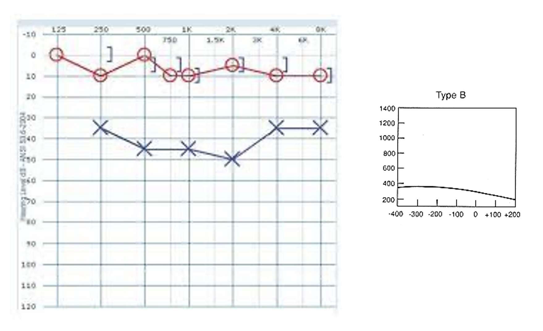 <p><span>ECV: Normal</span></p><p style="text-align: left;"><span>Otoscopy: No cerumen, reddened TM</span></p><p style="text-align: left;"><span>Symptoms: Fever, ear pain, difficulty hearing,</span></p><p style="text-align: left;"><span>tugging on ears, change in school performance</span></p>