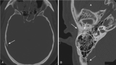 <p>- comminuted fx of right remporal bone (solid white arrows)</p><p>- fluid in the mastoid air cells (circle)</p><p>- air in the brain = pneumocephalus (dotted white arrow)</p>