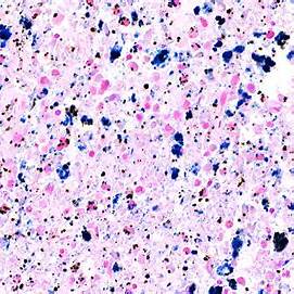 <p><em>iHisto. (n.d.). Prussian Blue-stained tissue demonstrating ferric iron deposits [Photomicrograph].</em></p>
