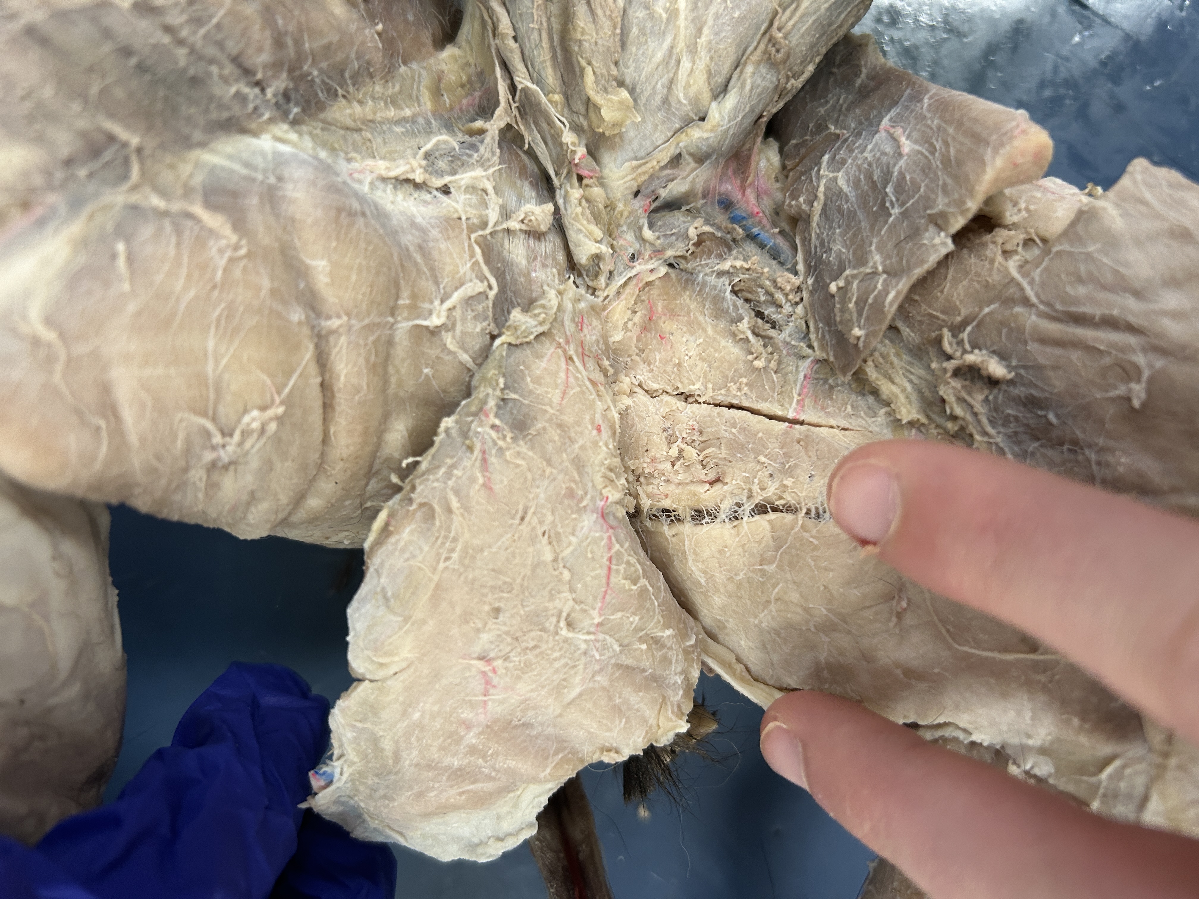 <p>Semimembraneous (under Adductor Femoris)</p>