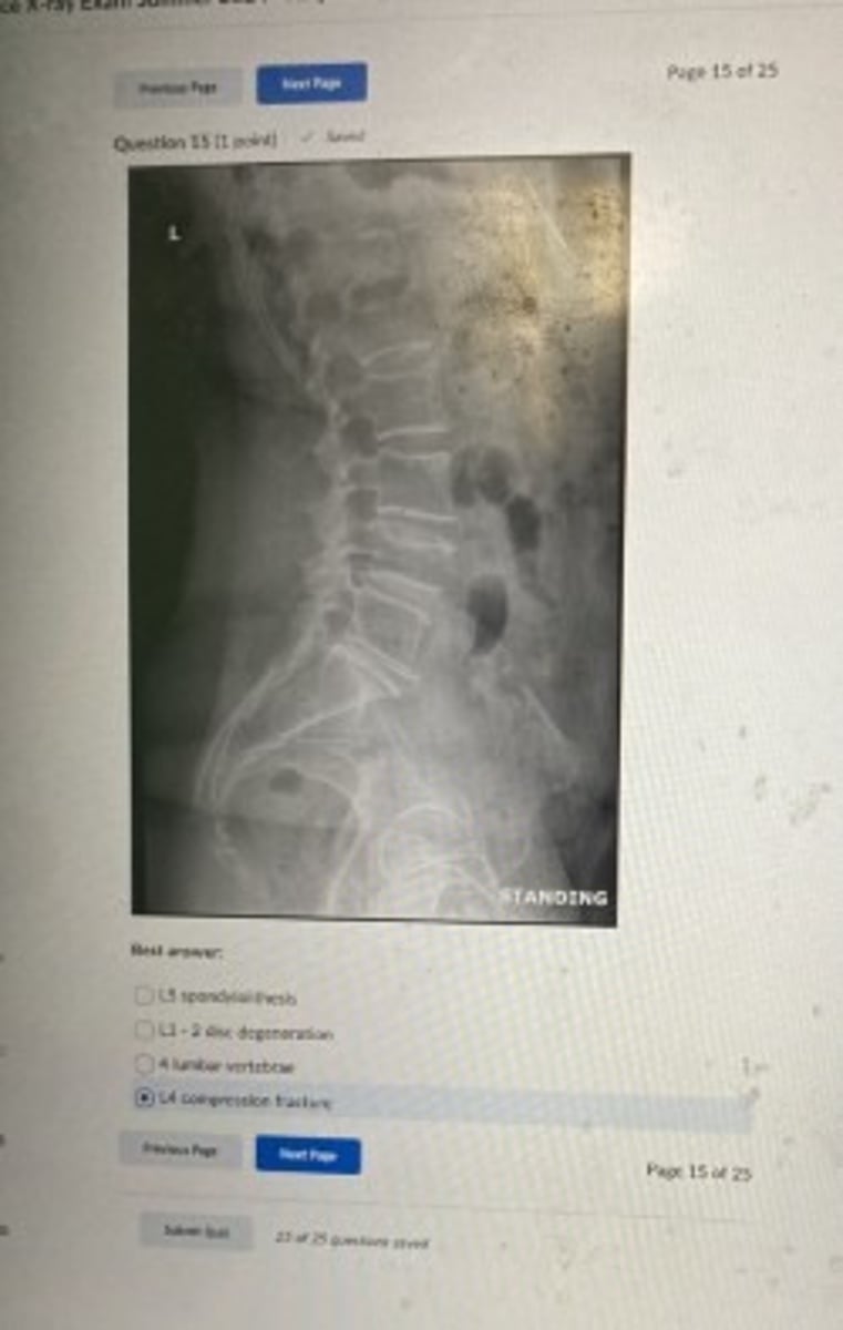 <p>L4 compression fracture</p>