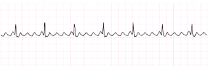 <ul><li><p class="Paragraph SCXW31104330 BCX8" style="text-align: left;"><span style="line-height: 20.85px;">Cause: CAD, Hypertension, Mitral valve disorders, Pulmonary embolus, Chronic lung disease, Cardiomyopathy, Hyperthyroidism, Alcohol and stimulants (cocaine, diet pills, caffeine, etc.) can contribute </span></p></li></ul><ul><li><p class="Paragraph SCXW31104330 BCX8" style="text-align: left;"><span style="line-height: 20.85px;">Tx: Primary goal is to slow ventricular response by increasing AV block </span></p></li></ul><ul><li><p class="Paragraph SCXW31104330 BCX8" style="text-align: left;"><span style="line-height: 20.85px;">Drugs to slow HR: Calcium channel blockers, -adrenergic blockers </span></p></li></ul><ul><li><p class="Paragraph SCXW31104330 BCX8" style="text-align: left;"><span style="line-height: 20.85px;">Cardioversion may be used to convert the atrial flutter to sinus rhythm emergently and electively </span></p></li></ul><ul><li><p class="Paragraph SCXW31104330 BCX8" style="text-align: left;"><span style="line-height: 20.85px;">Primary goal is to slow ventricular response by increasing AV block </span></p></li></ul><ul><li><p class="Paragraph SCXW31104330 BCX8" style="text-align: left;"><span style="line-height: 20.85px;">Anti-dysrhythmic drugs to convert atrial flutter to sinus rhythm or to maintain sinus rhythm (e.g., amiodarone) </span></p></li></ul><ul><li><p class="Paragraph SCXW31104330 BCX8" style="text-align: left;"><span style="line-height: 20.85px;">Radiofrequency catheter ablation can be curative therapy for atrial flutter </span></p></li></ul><p></p>