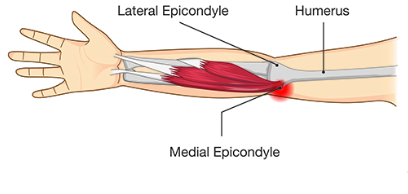 <p><span style="background-color: transparent;"><strong>What is the name of the injury shown in the picture below?</strong></span></p><p></p>