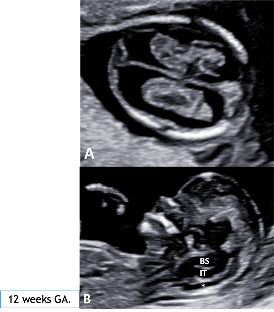 <p>fetal head: 11-14 wks GA (1st tri)</p>