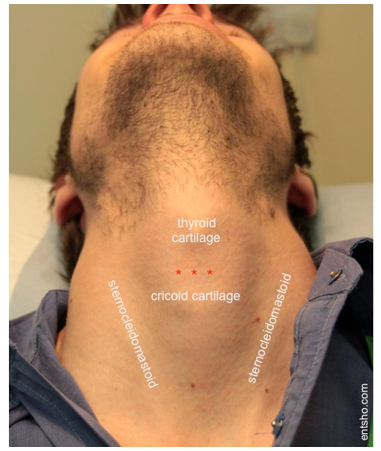 <p>A thin membrane that connects the cricoid cartilage to the thyroid cartilage. </p><ul><li><p>Cricothyroidotomy </p><ul><li><p>A tube can be inserted through this ligament to provide an emergency airway</p></li></ul></li></ul><p></p>