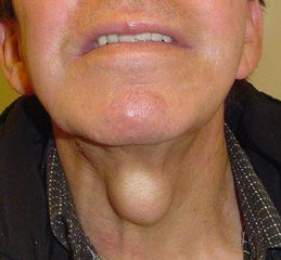 <p>conducto tirogloso no desaparece</p><p>en línea media del cuello/ trayecto de descenso</p><p>se mueve al tragar y sacar la lengua</p>
