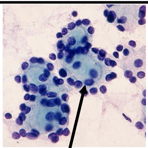 <p>1) Diagnostic cytologique bethesda</p><p></p>