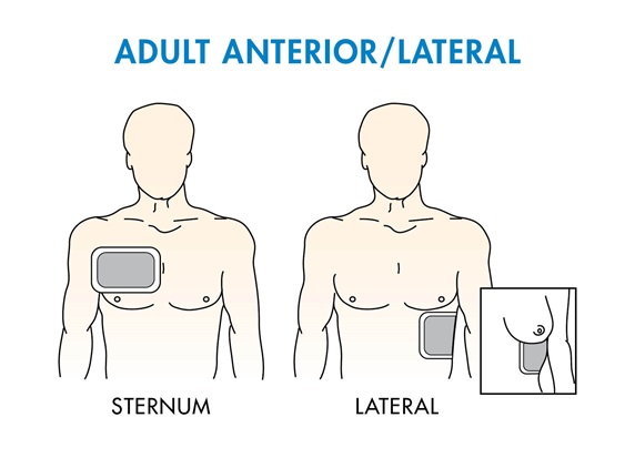<ul><li><p>lateral pad (usually has a <span data-name="heart" data-type="emoji">❤</span>︎ on it) centered along 5th intercostal space mid-axillary line</p></li><li><p>anterior pad placed mid-clavicular line just below clavicle</p></li></ul><p></p>