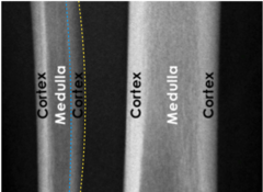 <p>compact bone surrounding the medulla and adjacent to periosteum</p>