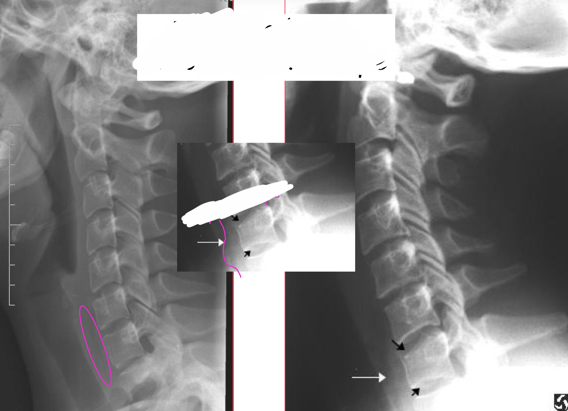 <p>What abnormal soft tissue is found on this x-ray </p>