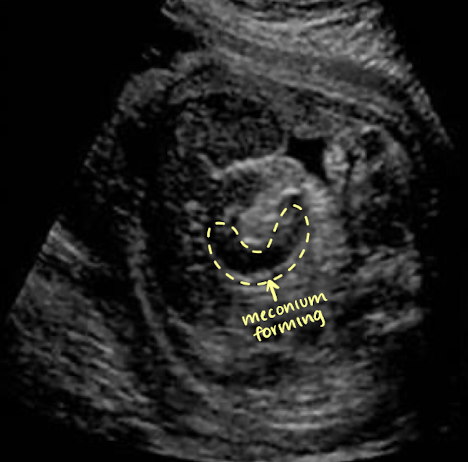<ul><li><p>seen after 22w (can discern between small and large)</p></li><li><p>more peripherally than small bowel</p></li><li><p>hypoechoic tubular structure (meconium)</p><ul><li><p>meconium=baby stool</p></li></ul></li><li><p>well-defined walls</p></li><li><p>haustral folds appear as thin linear echoes within lumen</p></li></ul><p></p>
