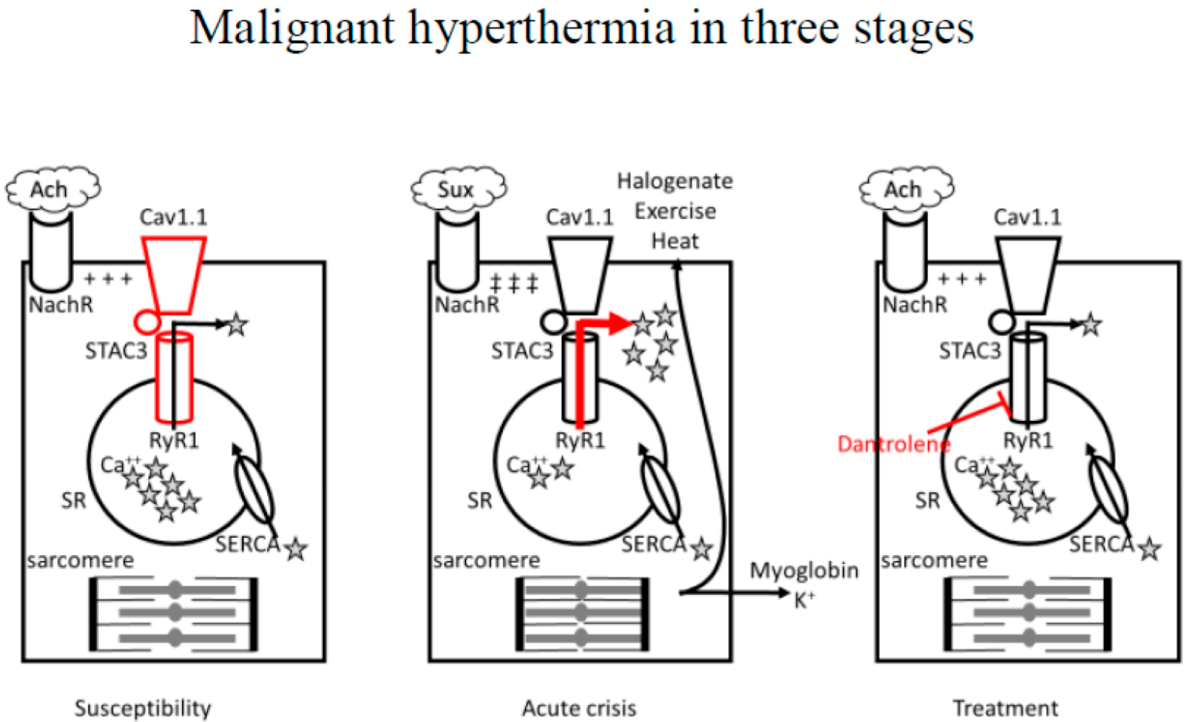 <p><em><u>Malignant Hyperthermia</u></em> - Genetic condition where abnormal <strong><em><mark data-color="green" style="background-color: green; color: inherit;">RyR receptors</mark></em></strong> remain open <strong><em><mark data-color="red" style="background-color: red; color: inherit;">longer than normal</mark></em></strong>, allowing excess Ca2+ to be released from the sarcoplasmic reticulum.</p><ul><li><p>Excess Ca2+ in the cytoplasm, turnover by SERCA pumps cannot catch up, leading to Ca2+ remaining bound to troponin for longer than necessary.</p></li></ul><ul><li><p>Thus, myosin heads remain clamped onto actin filaments for long periods of time</p></li><li><p>Muscle remains contracted for an extended period of time - ensuing <strong>muscle cramps</strong></p></li><li><p>SERCA pumps work overtime (consuming lots of ATP → ADP + Pi), releasing heat in the catabolic reaction</p></li><li><p>Muscle cells/fibres can <strong><em><mark data-color="red" style="background-color: red; color: inherit;">melt</mark></em></strong> from the heat</p><ul><li><p>Also excess Ca2+ triggers enzymes that cause muscle-breakdown (rhabdomyolysis) - resulting in dark/red urine</p><ul><li><p>If left untreated, can lead to kidney failure or even death</p></li></ul></li><li><p>Often found during surgery, as <mark data-color="blue" style="background-color: blue; color: inherit;">certain anaesthetics</mark> can trigger the RyR channels <strong>directly</strong></p></li><li><p><mark data-color="blue" style="background-color: blue; color: inherit;">Muscle relaxant Succinylcholine</mark> can also trigger MH</p></li></ul></li></ul><p></p>