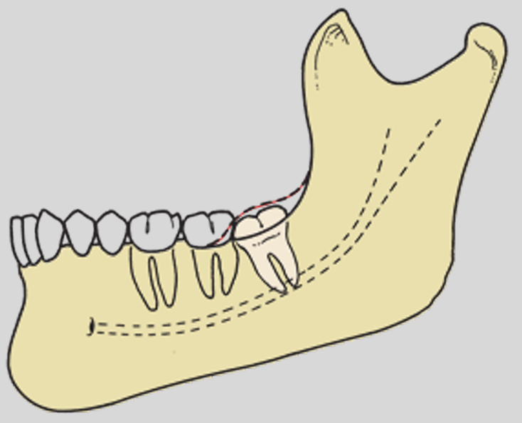 <p>what is the classification of overlying tissue?</p>