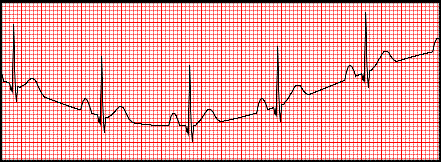 <p>artifact caused by patient movement, bad skin prep, bad lead attachment</p><p>looks like ekg not staying in the middle</p>