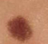 <p>junctional common pigmented nevi*</p>