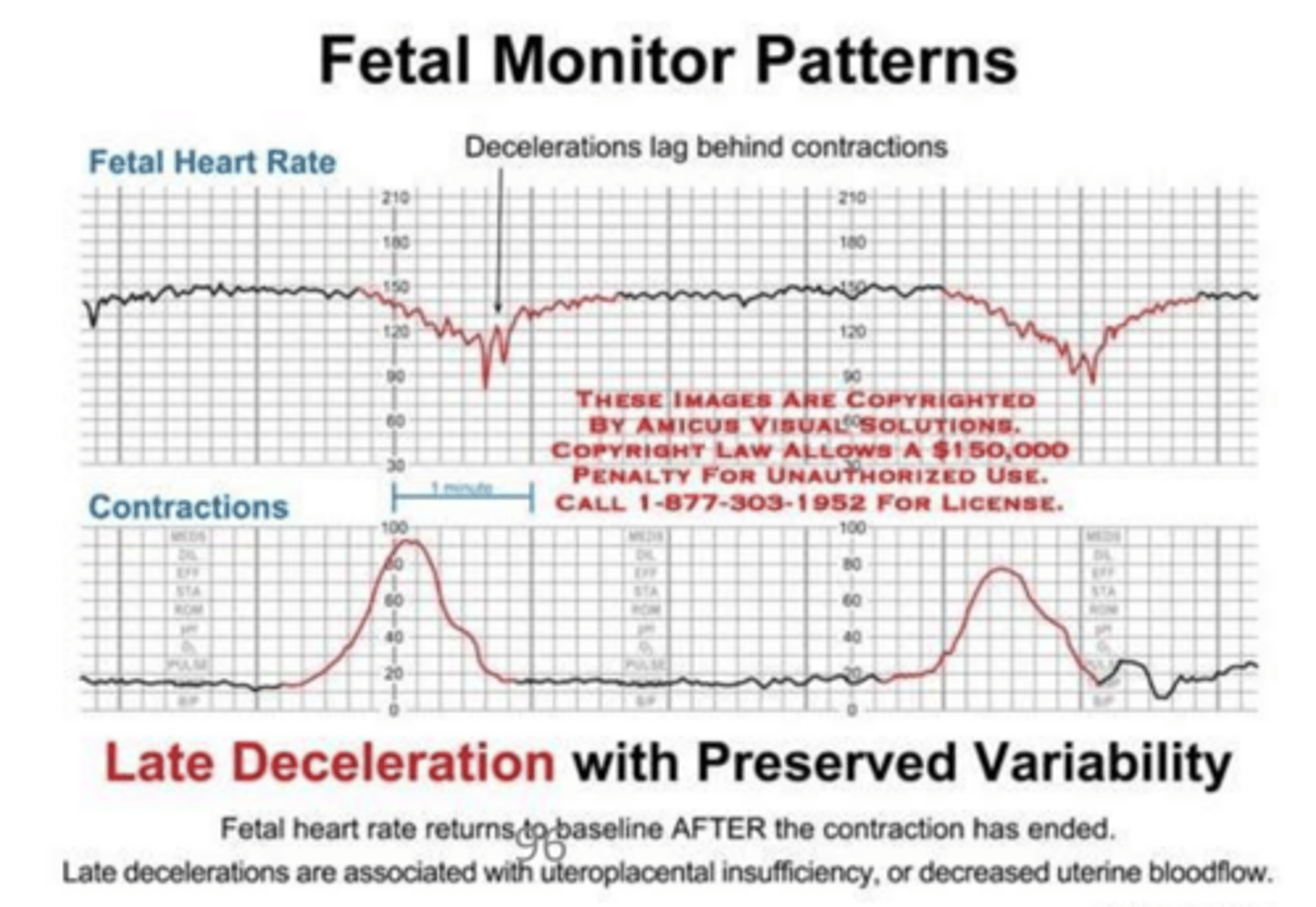 <p>Falls in heart rate after contraction has started seen with fetal hypoxia</p>