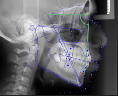 <p>What skeletal measurement:</p><p>- Sella-Nasion vs Nasion-B Point</p><p>- AP relationship between the cranial base and the mandible</p><p>- Tells you about the AP position of the mandible</p>