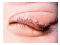 <p>What is the most likely diagnosis ?</p>
