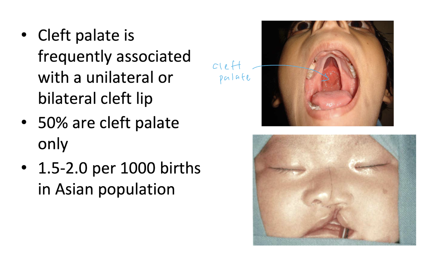 <ul><li><p>CP freq associated with uni/bilateral CL</p></li></ul><p></p>
