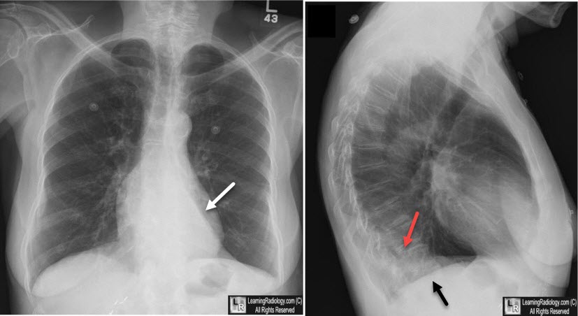<p>Frontal view: Triangular retrocardic opacity main feature.<br>Lateral view: Flat waist sign = flattening of left heart border due to posterior shift of hilar structures and resultant cardiac rotation.</p>