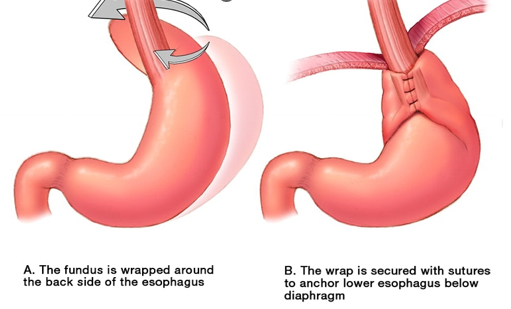 <p>fundoplication </p>