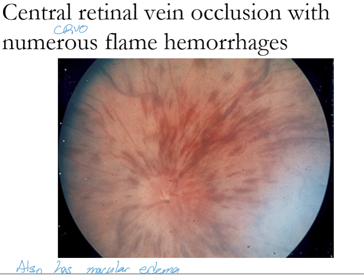 <ul><li><p>Branch retinal vein occlusion (BRVO) → sectoral flame hemes</p></li><li><p>Hemicentral RVO → about half the retina</p></li><li><p>Central retinal vein occlusion (CRVO) → widespread, nearly entire retina</p></li></ul><p></p>