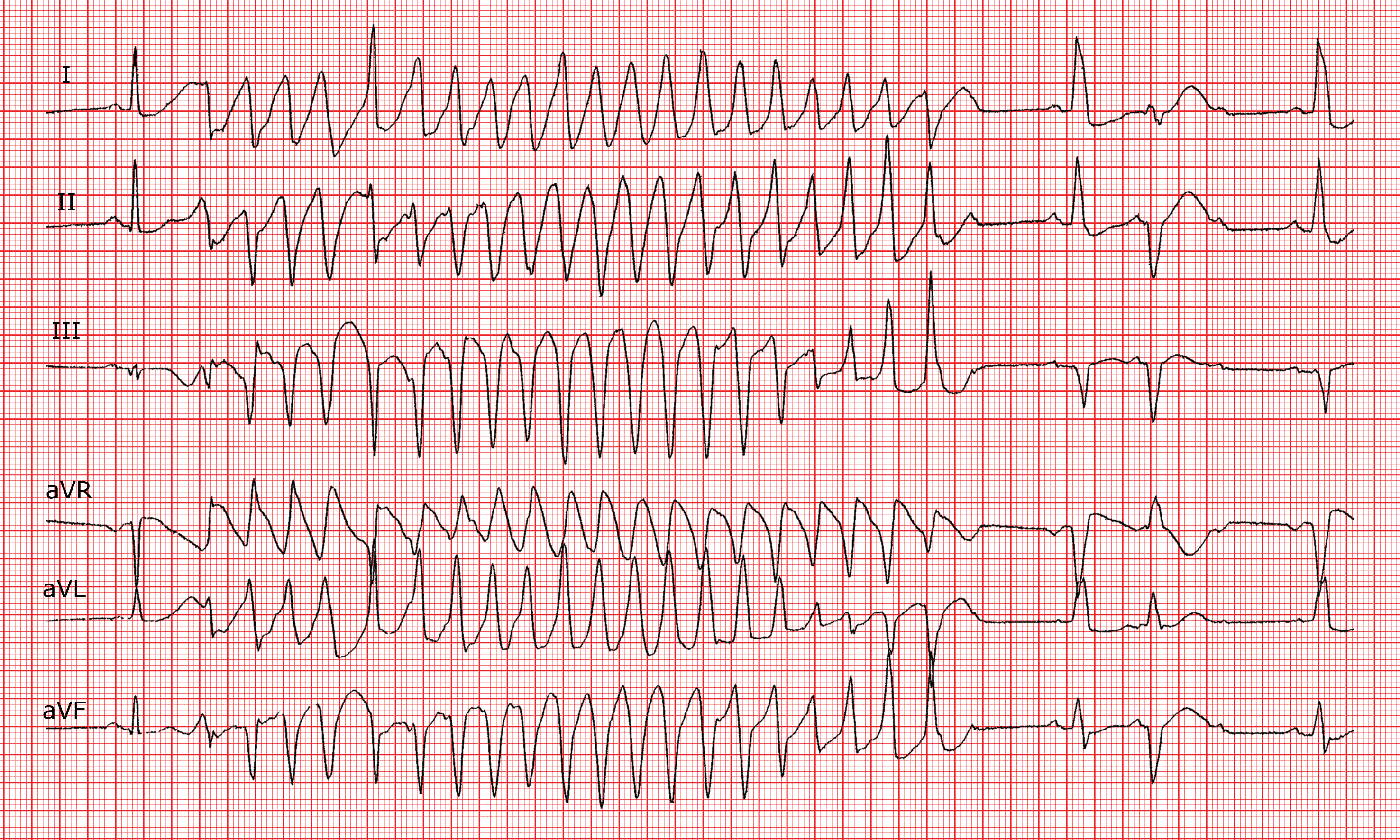 <p>Paroxysmal form of polymorphic VT, occurring secondary to QT prolongation</p>