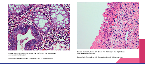 <p><span style="color: red;">disordered growth of epithelium</span>. There is a <span style="color: red;">loss</span> of cellular<span style="color: red;"> uniformity and architectural orientation.</span> The cells may have an increased number of mitotic figures.</p><ul><li><p>Doesn’t always form a mass or tumor<strong><u> therefore not always referring to a neoplasm</u></strong></p></li><li><p>Can be reversible, if the inciting agent is removed</p></li></ul><p></p>