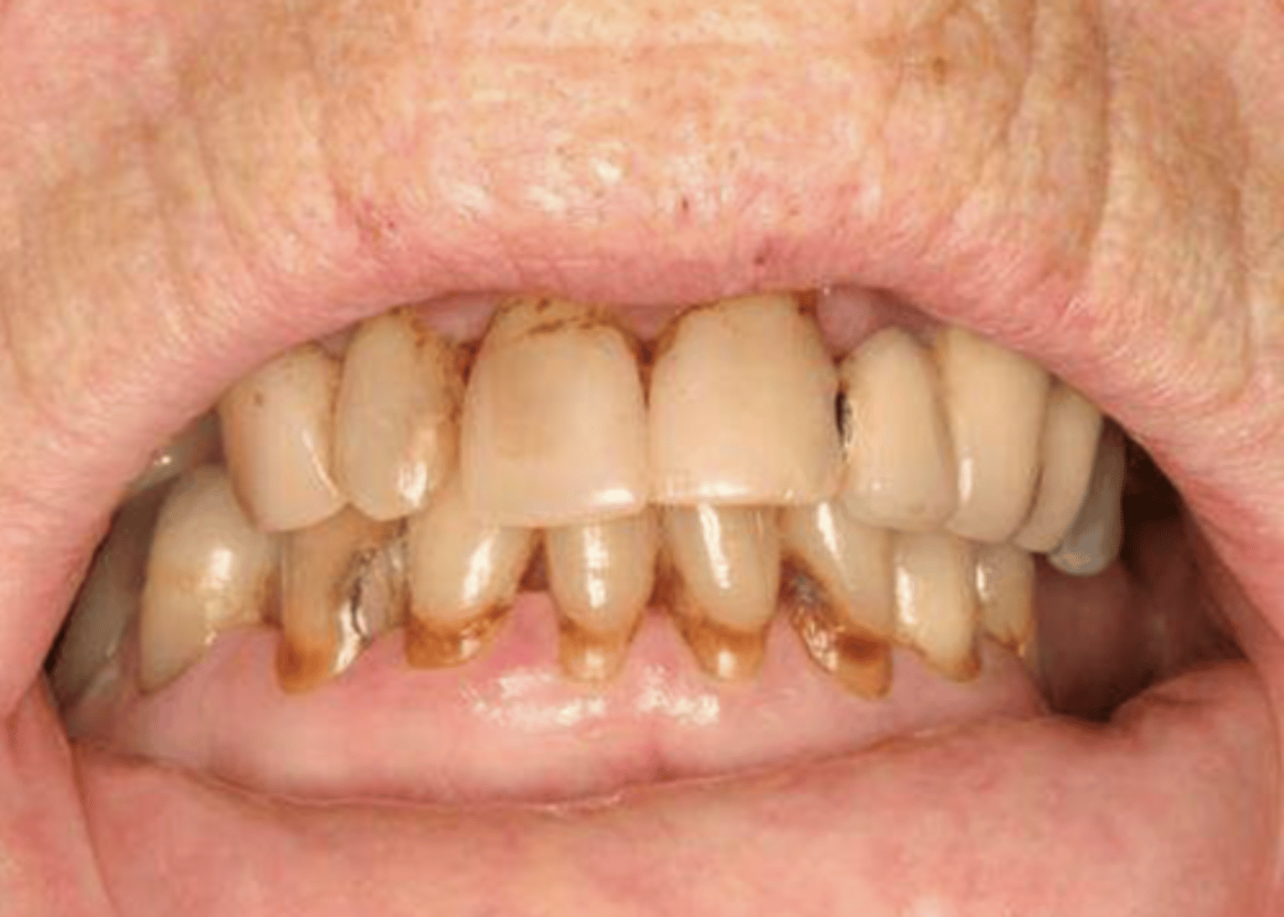 <p>- Xerostomia</p><p>- Dysphagia</p><p>- Cervical caries</p><p>- Fissured tongue with atrophy of papillae</p><p>- Secondary candidiasis</p>