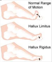<p>Match the deformity: Limited motion, especially extension/dorsiflexion, of the great toe at the 1st MTP joint PROM <70 deg. Plantar hallux IP ulcers</p><p>A. Hallux valgus</p><p>B. Bunion</p><p>C. Bunionette</p><p>D. Hammer toe</p><p>E. Claw toe</p><p>F. Mallet toe</p><p>G. Pes equinus</p><p>H. Pes cavus</p><p>I. Pes planus</p><p>J. Hallux limitus</p><p>H. Hallux rigidus</p><p>I. Charcot arthropathy</p><p>J. Plantar flexed 1st ray</p>