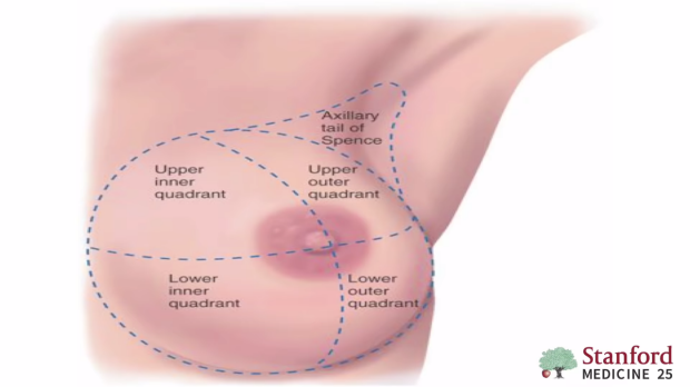 <p><span style="color: yellow;"><strong>upper outer quadrant</strong></span></p><p>(more tissue +axillary drainage)</p><ul><li><p>Most common first site of breast cancer lymphatic metastasis = axillary nodes, particularly the sentinel lymph node.</p></li></ul><p><sup><br>Lateral breast → Axillary<br>Medial breast → Internal mammary/parasternal</sup></p>