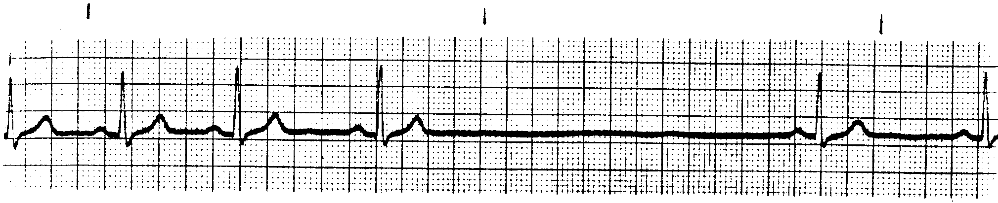 <p>What ECG is this </p>