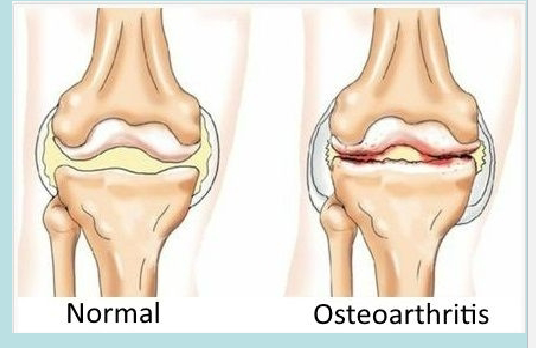 <ul><li><p>Articular cartilage → caps the ends of bones</p></li><li><p>Joint Cavity → space that contains synovial fluid which acts like a lubricant to reduce friction</p></li><li><p>Articular Capsule → double-layered consists of an outer fibrous capsule and an inner synovial membrane </p></li><li><p>Ligaments that reinforce synovial joints → 3 types based on their location in relation to the articular capsule</p><ul><li><p>Capsular or intrinsic ligaments → located inside the fibrous capsule </p><ul><li><p>Example: medial collateral ligaments</p></li></ul></li><li><p>Extracapsular ligaments → located external to the articular capsule </p><ul><li><p>Example: Tibial collateral ligaments</p></li></ul></li><li><p>Intracapsular ligaments → located deep to the articular capsule</p><ul><li><p>Example: anterior cruciate ligament (ACL) → a blow to the front of the extended knee tears the ACL (common sports injury)</p></li></ul></li></ul></li><li><p>Menisci → discs of fibrocartilage that extend from the articular capsule into the synovial cavity to improve the fit of a synovial joint to minimize wear and tear</p></li><li><p>Bursae → flattened fibrous sacs that contain synovial fluid to reduce friction where bones, tendons, ligaments, and muscles rub together</p></li><li><p>Tendon Sheaths → elongated bursae that wrap completely around tendons subjected to a lot of friction; tendon sheaths reduce friction</p></li></ul><p></p>