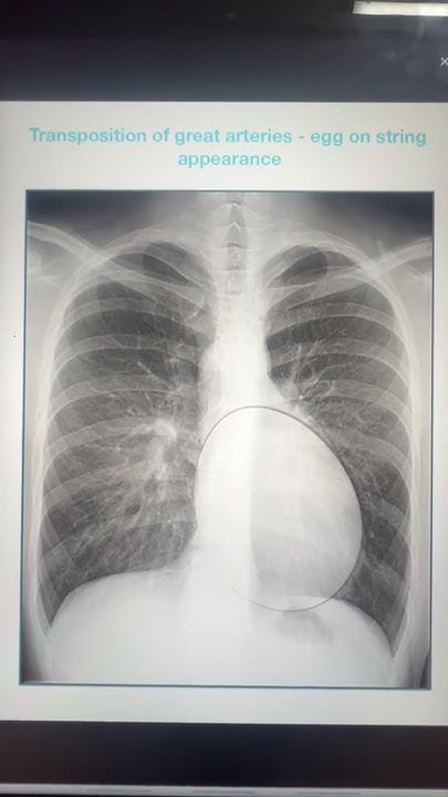 <p>transplantation of great arteries 2n1s</p>