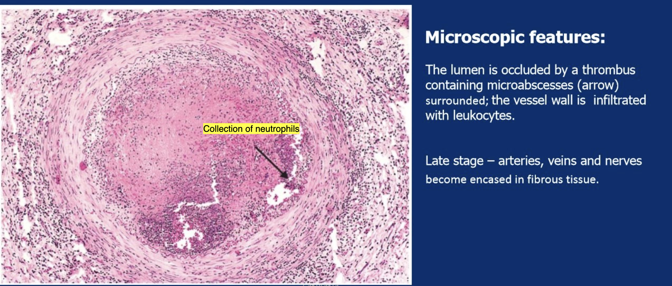 <p>Lumen occluded by thrombus containing microabscesses (neutrophilic); vessel wall infiltrated with leukocytes</p>